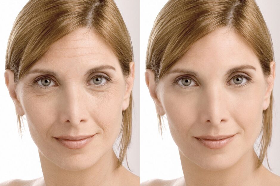 Esperienza di utilizzo prima e dopo l'utilizzo della crema intenskin di Milana