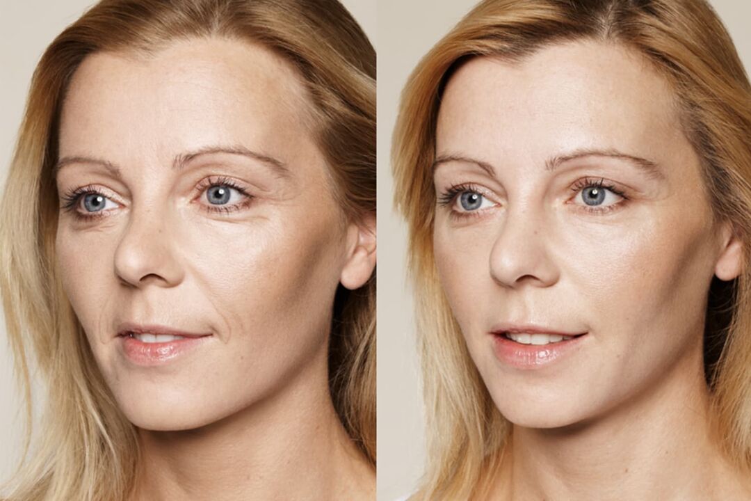 Esperienza di utilizzo prima e dopo l'utilizzo della crema intenskin di Valeria